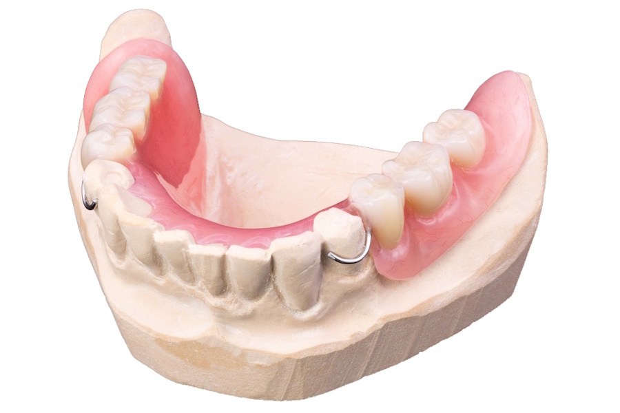 Нижний протез зубов какой. Съемный пластинчатый протез (1 пластина). Пластиночные зубные протезы на нижнюю челюсть. Частично съемным платиночный протез. Съемный пластиночный протез.